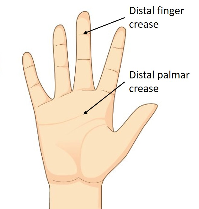 How to measure for a finger splint
