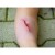 Erler Zimmer Wound Moulage Cut Wound with Glass Fragment