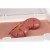 Erler Zimmer Wound Moulage Protrusion of Large Intestines