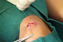 Sutures