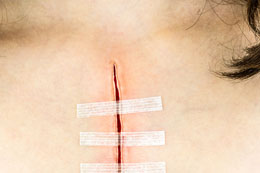 Wound Closure Strips