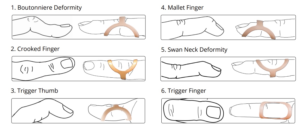 Correctly fitting your finger splint based on your condition is vital How to correctly fit your splint based on your condition