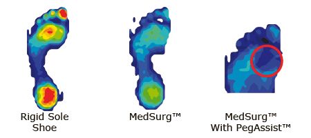 How the Shoe Reduces Pressure on the Foot