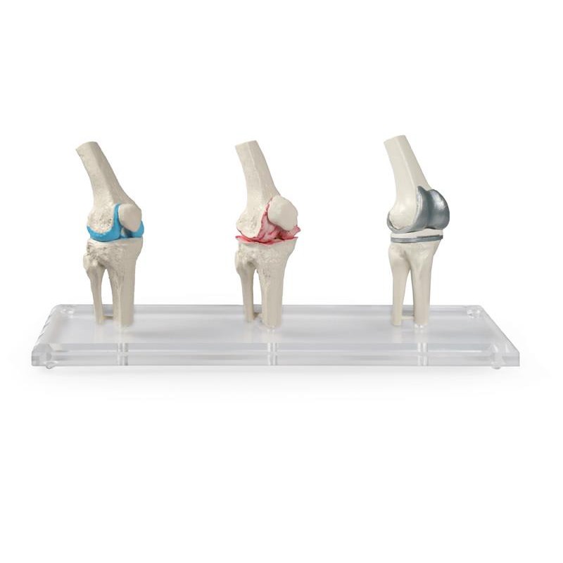 Erler-Zimmer Knee Joints Model - MedicalSupplies.co.uk