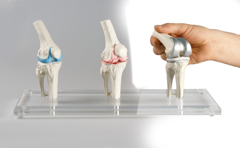 Erler-Zimmer Knee Joints Model - MedicalSupplies.co.uk
