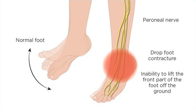 Drop Foot Informational Diagram Image