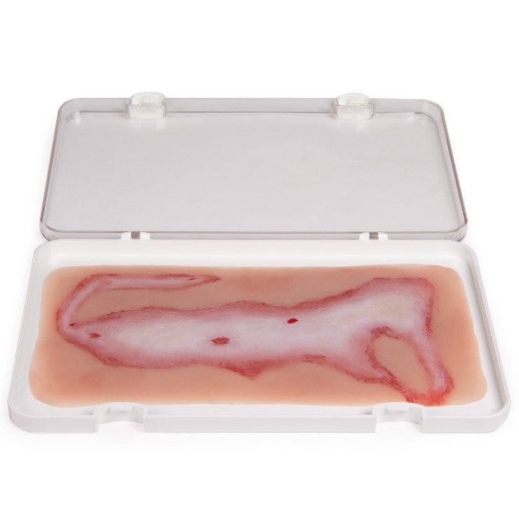 Erler Zimmer Scalding Wound Moulage MedicalSupplies.co.uk