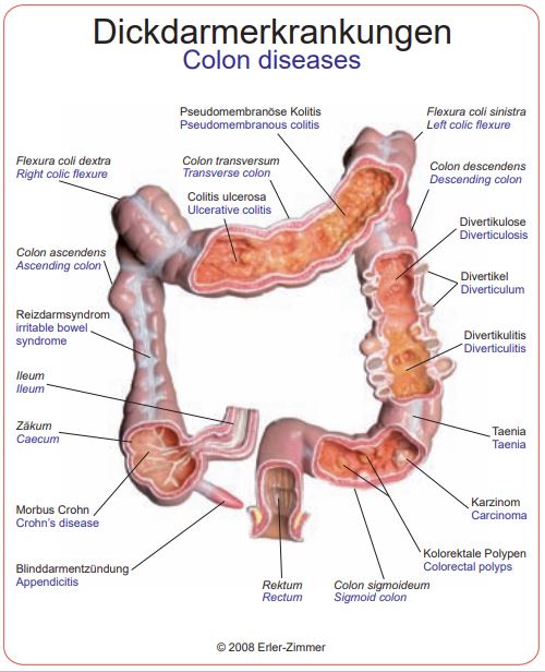 Erler-Zimmer Diseased Colon Model - MedicalSupplies.co.uk