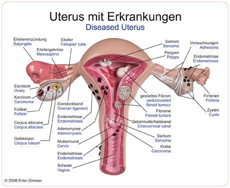 Erler Zimmer Diseased Uterus Model L262 Key Card
