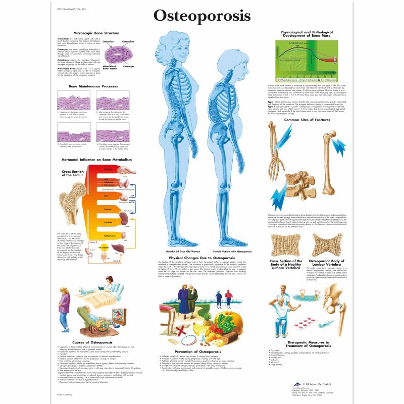 Osteoporosis Chart MedicalSupplies.co.uk