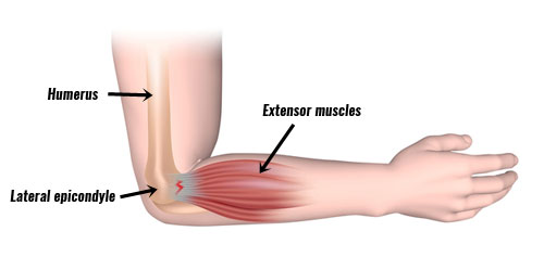 Informational Diagram Showing Humerus, Lateral Epicondyle 