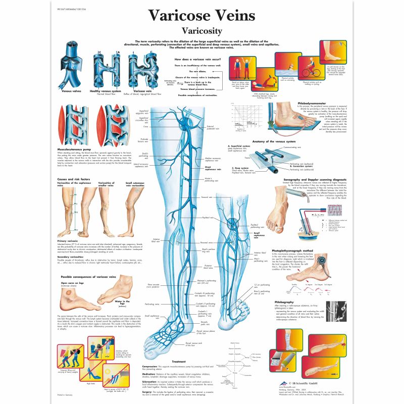 Varicose Veins Chart MedicalSupplies co uk