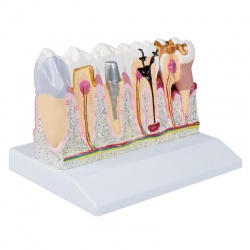 Erler-Zimmer Dental Model with Lower Jaw and Teeth (4x Life-Size)