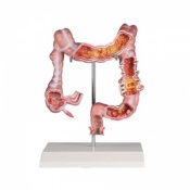 Erler-Zimmer Diseased Colon Model