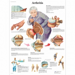 Arthritis Chart