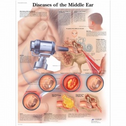 Diseases of the Middle Ear Chart