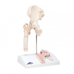 Femoral Fracture and Hip Osteoarthritis Model