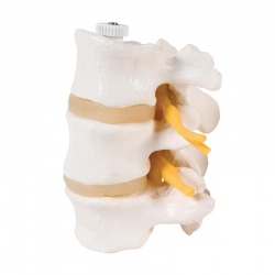 Two Lumbar Vertebrae with Prolapsed Disc