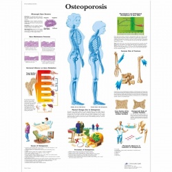 Osteoporosis Chart