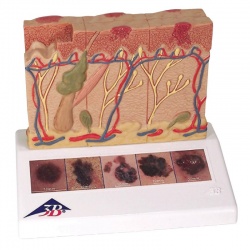 Skin Cancer Model