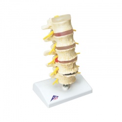 Stages of Disc Prolapse and Vertebral Degeneration Model