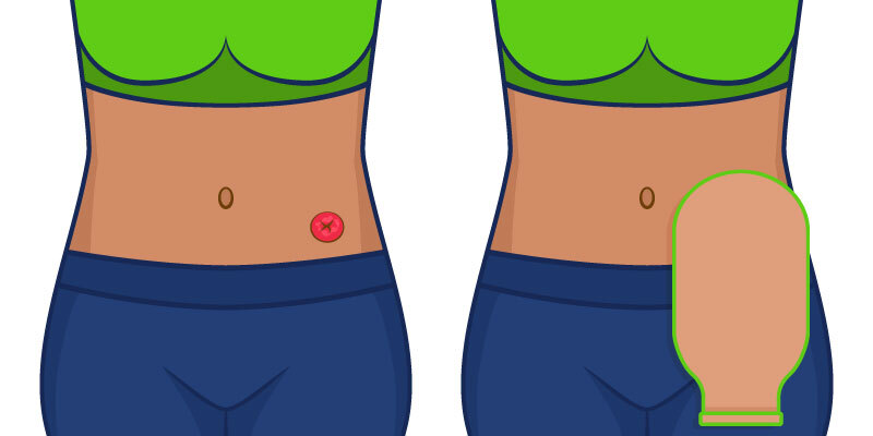 graphic depicting a woman with a stoma and ostomy bag